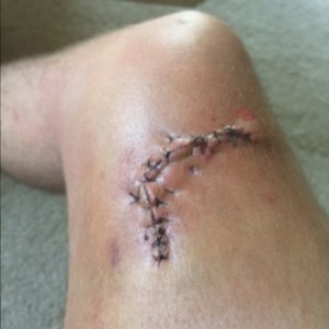 Healing up fast!
