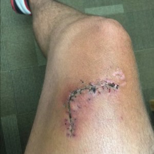 Stitches are out!