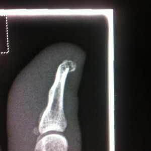 Broke the tip off my thumb. Fak