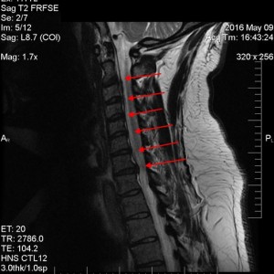 Herniated_discs